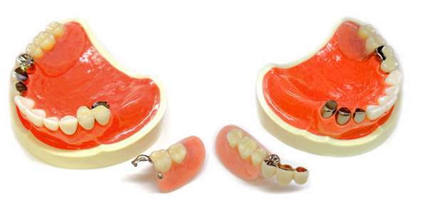 左右のアタッチメント義歯の入れ歯・小型化が可能・港区麻布十番