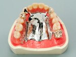 金属義歯・部分入れ歯タイプ