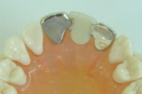 ウイングアタッチメント・前歯の治療
